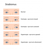 Accommodative Esotropia-Oakville Centre for Vision-9053382020 x221